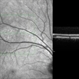 Unilateral Acute Idiopathic Maculopathy Unilateral Acute Idiopathic Maculopathy